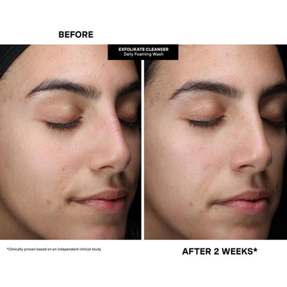 Kate Somerville Pore-fect Skin Edit Travel Kit: ExfoliKate, EradiKate & Goat Milk Cleanser Holiday Gift Set Avelisse