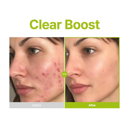 PURITO Azelaic Acid 10% + Kojic Acid + Tea Tree Facial Serum - Blemish-Prone Skin Korean Skincare, 30mL (1.01 fl.oz) Avelisse