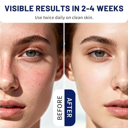Milia Remover Treatment for Face & Eyes - Salicylic Acid Serum for Fat Granule Clearing, Acne Spot Treatment, Skin Smoothing Essence (1 Fl Oz) Avelisse