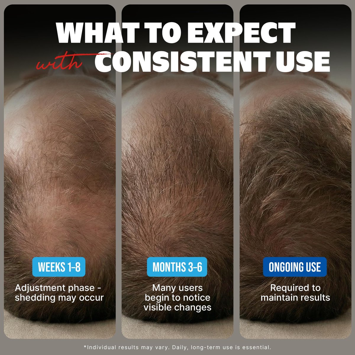 Kirkland Minoxidil for Men Liquid, Extra Strength Hair Regrowth Treatment 5%, 6 Months Supply - Upgraded Dropper Applicator and Bonus Free Guide Included Avelisse