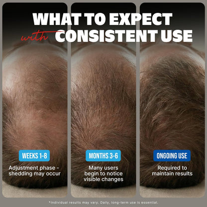 Kirkland Minoxidil for Men Liquid, Extra Strength Hair Regrowth Treatment 5%, 6 Months Supply - Upgraded Dropper Applicator and Bonus Free Guide Included Avelisse