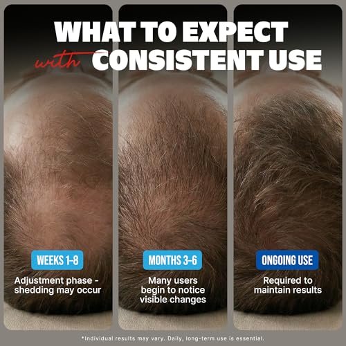 Kirkland Minoxidil for Men Liquid, Extra Strength Hair Regrowth Treatment 5%, 6 Months Supply - Upgraded Dropper Applicator and Bonus Free Guide Included Avelisse