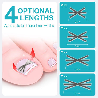 VITASY Ingrown Toenail Treatment Kit – Upgraded 6-Angle Shape Titanium Alloy Corrector with 4 Multi-Size Strips for Curved Toenail Quick Relief (8 Pieces, Silver) Avelisse