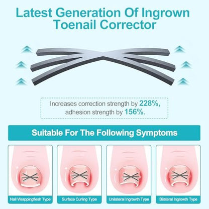 VITASY Ingrown Toenail Treatment Kit – Upgraded 6-Angle Shape Titanium Alloy Corrector with 4 Multi-Size Strips for Curved Toenail Quick Relief (8 Pieces, Silver) Avelisse