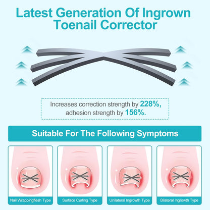 VITASY Ingrown Toenail Treatment Kit – Upgraded 6-Angle Shape Titanium Alloy Corrector with 4 Multi-Size Strips for Curved Toenail Quick Relief (8 Pieces, Silver) Avelisse