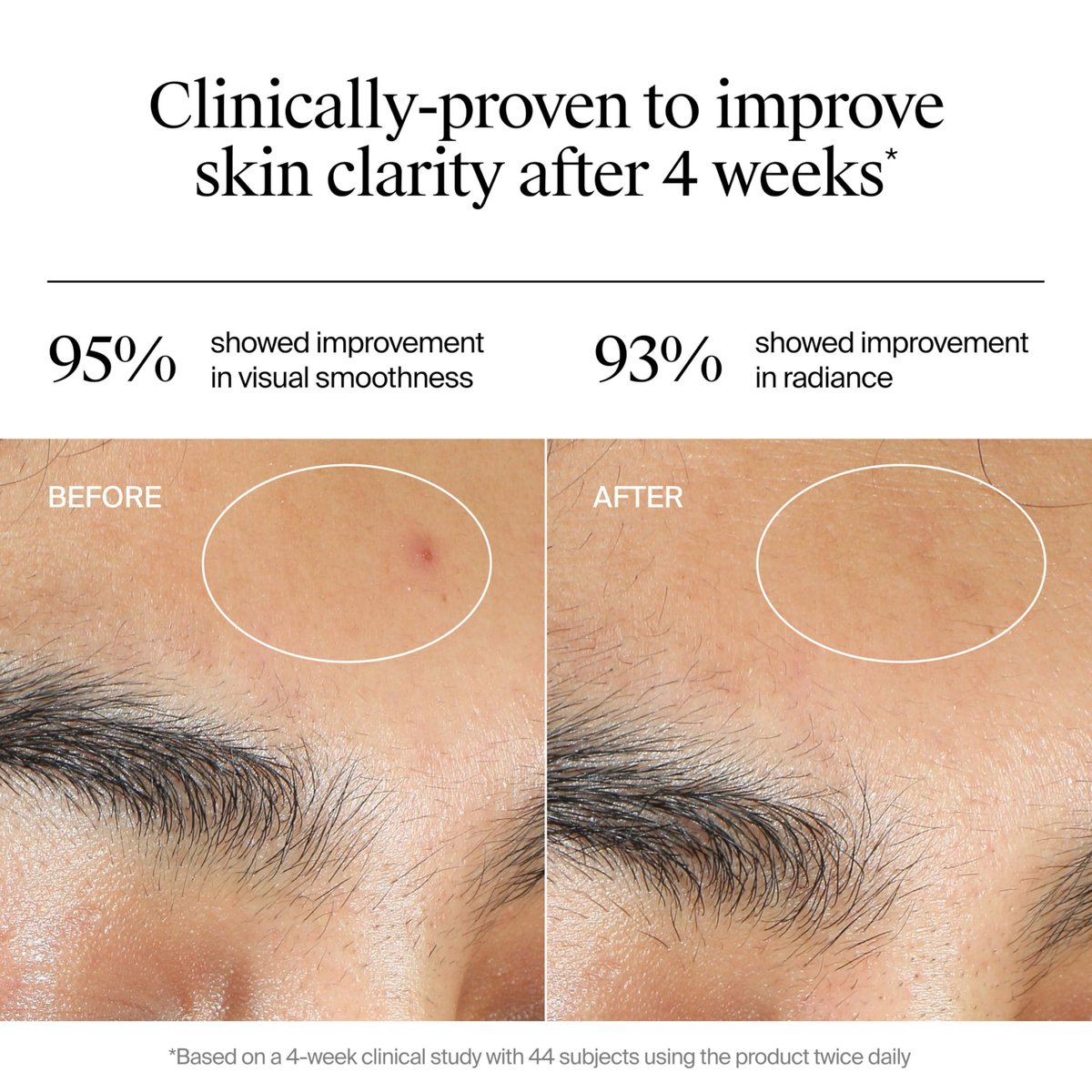 Neutrogena Evenly Clear Acne Gel Moisturizer with Salicylic Acid & N-Acetyl Glucosamine, Lightweight Non-Greasy Face Moisturizer for Acne-Prone Skin, 1.7 fl. oz - görsel 11