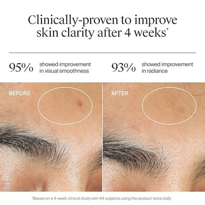 Neutrogena Evenly Clear Acne Gel Moisturizer with Salicylic Acid & N-Acetyl Glucosamine, Lightweight Non-Greasy Face Moisturizer for Acne-Prone Skin, 1.7 fl. oz