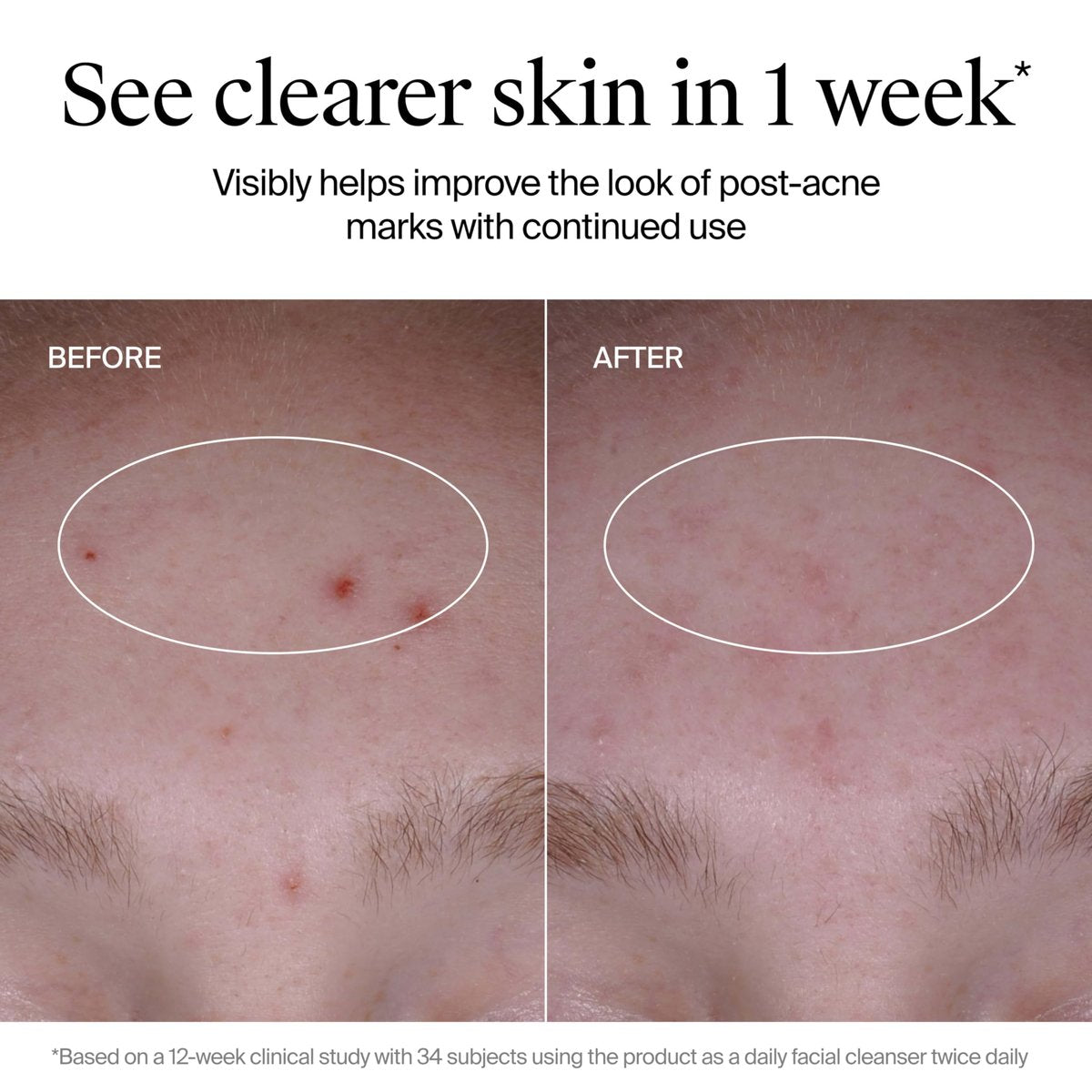 Neutrogena Evenly Clear Acne Cleanser with 2% Salicylic Acid & 2% PHA Exfoliant, Gentle Foaming Face Wash for Clogged Pores, Blackheads & Post-Acne Marks, 9.1 fl. oz - görsel 11