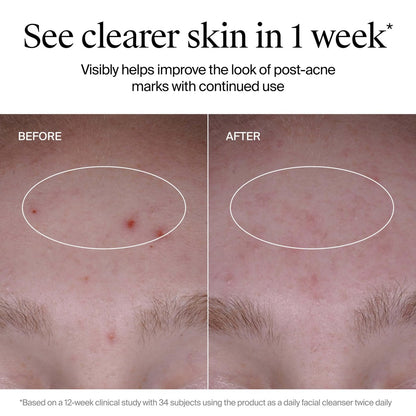 Neutrogena Evenly Clear Acne Cleanser with 2% Salicylic Acid & 2% PHA Exfoliant, Gentle Foaming Face Wash for Clogged Pores, Blackheads & Post-Acne Marks, 9.1 fl. oz