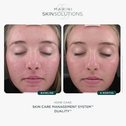 Marini SkinSolutions Duality Benzoyl Peroxide 10% Acne Treatment Cream & Anti-Aging Retinol - Reduce Acne, Blemishes, Fine Lines & Wrinkles - Cruelty Free - Made in USA - 1 oz Avelisse