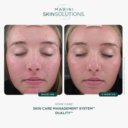 Marini SkinSolutions Duality Benzoyl Peroxide 10% Acne Treatment Cream & Anti-Aging Retinol - Reduce Acne, Blemishes, Fine Lines & Wrinkles - Cruelty Free - Made in USA - 1 oz Avelisse