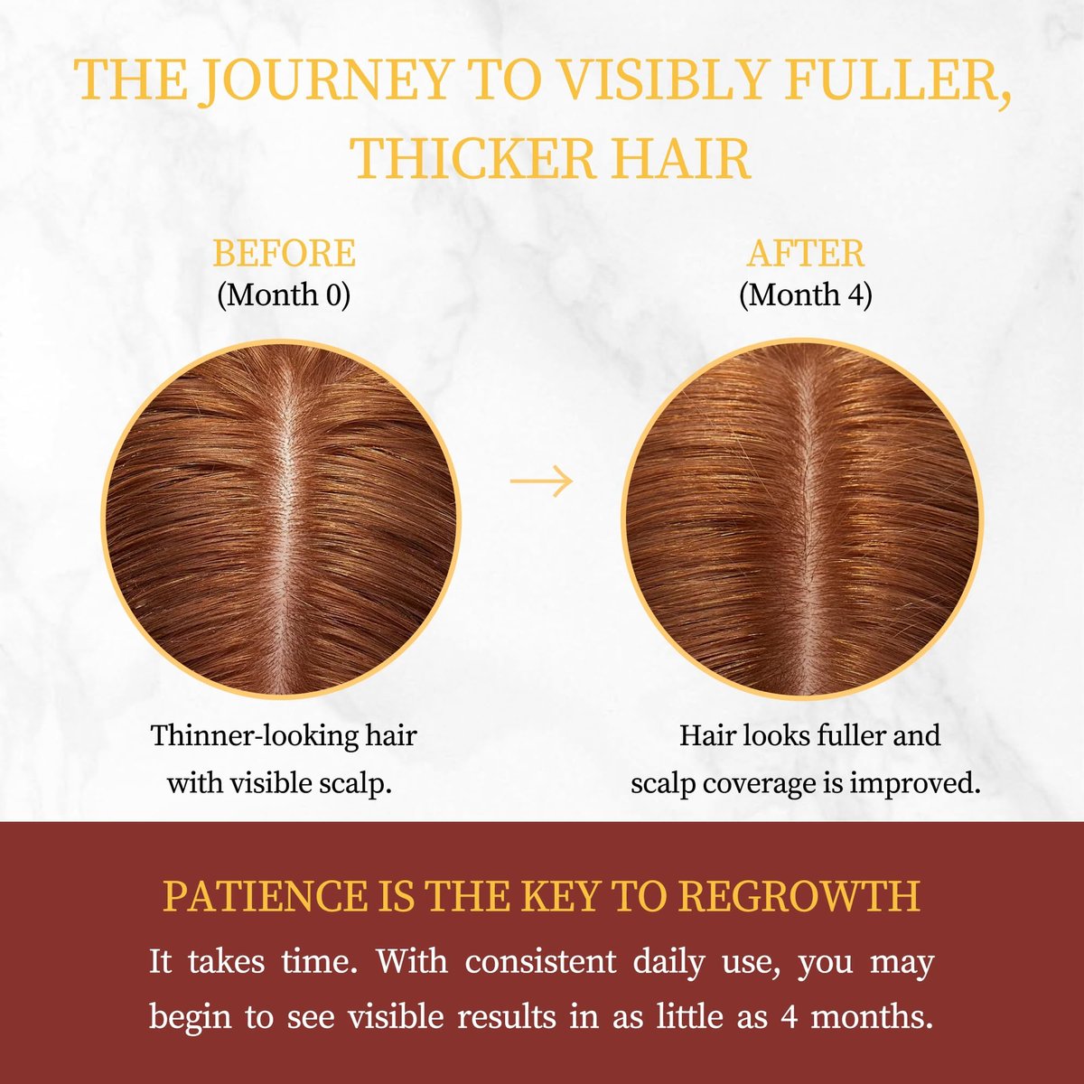 Minoxidil for Women Hair Growth with Biotin, Extra Strength Topical Minoxidil Serum Solution with Rosemary for Hair Regrowth Treatments, Non-Greasy, Helps Prevent Hair Thinning & Hair Loss Avelisse