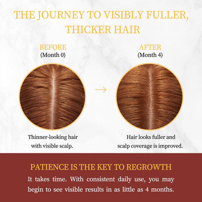 Minoxidil for Women Hair Growth with Biotin, Extra Strength Topical Minoxidil Serum Solution with Rosemary for Hair Regrowth Treatments, Non-Greasy, Helps Prevent Hair Thinning & Hair Loss Avelisse