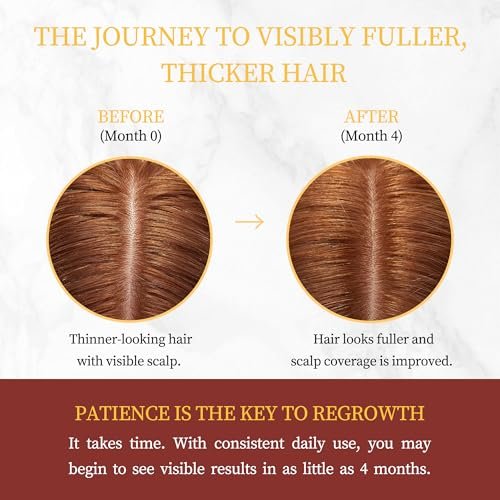 Minoxidil for Women Hair Growth with Biotin, Extra Strength Topical Minoxidil Serum Solution with Rosemary for Hair Regrowth Treatments, Non-Greasy, Helps Prevent Hair Thinning & Hair Loss Avelisse