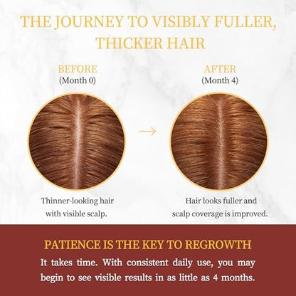 Minoxidil for Women Hair Growth with Biotin, Extra Strength Topical Minoxidil Serum Solution with Rosemary for Hair Regrowth Treatments, Non-Greasy, Helps Prevent Hair Thinning & Hair Loss Avelisse