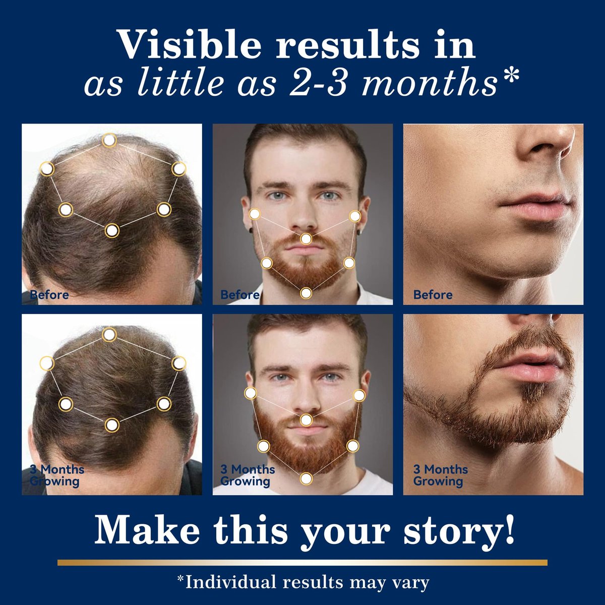 5% Minoxidil Hair Growth for Men and Women: Extra Strength Topical Solution with Biotin - Regrowth Serum for Beard and Scalp, 2-Pack - görsel 5