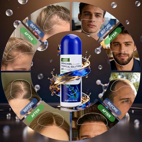 6 Pack 5% Minoxidil for Men and Women – Biotin-Infused Hair & Beard Growth Serum with Sponge Applicator, 8-Month Supply (6 x 2.7 FL OZ) Avelisse