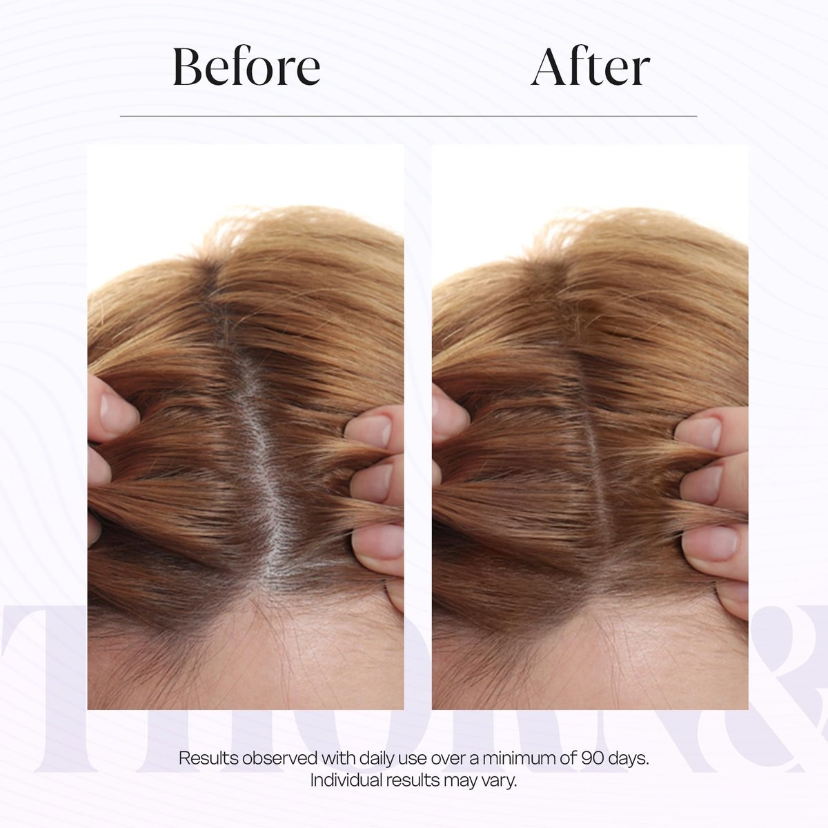 THORN & BERRY Hair Growth Serum for Thinning Hair | Thicker Fuller Hair Thickening Serum with Rosemary Oil, Saw Palmetto, Biotin, Multi Peptides, Redensyl & Caffeine | Density DHT Blocker for Women Avelisse