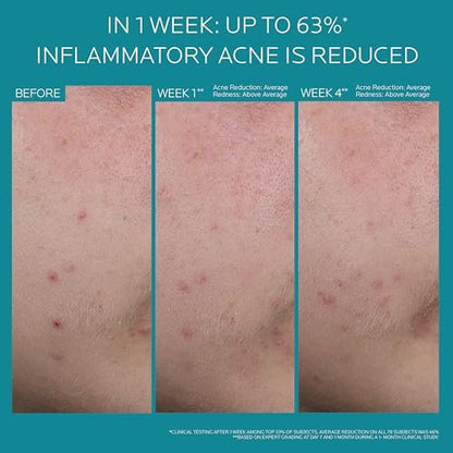 La Roche-Posay Effaclar BPO Multi-Target Acne Treatment with 5.5% Micronized Benzoyl Peroxide - Acne Cream for Face, Targets Oily Skin, Blackheads & Prevents Pimples, 20ml Avelisse