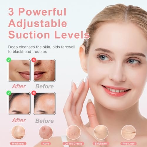 2026 Pore Vacuum Blackhead Remover - USB Rechargeable with 5 Heads & Spatula for Face Deep Cleansing Avelisse