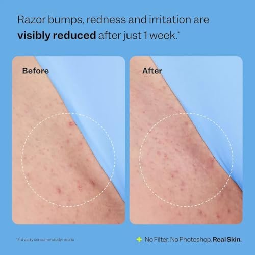 BETTENKO Smoothing Solution Ingrown Hair Treatment Serum – Soothe Razor Bumps, Bikini Line & More | 1.69 Fl Oz Avelisse