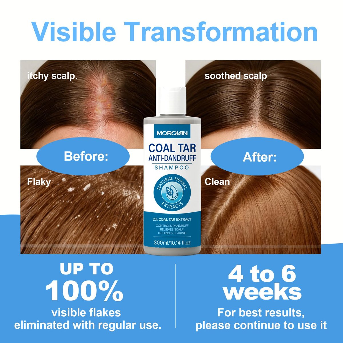 Morovan Coal Tar Dandruff Shampoo - 2% Coal Tar Extract for Severe Dandruff, Psoriasis & Itchy Scalp | Medicated Treatment for Seborrheic Dermatitis - görsel 9