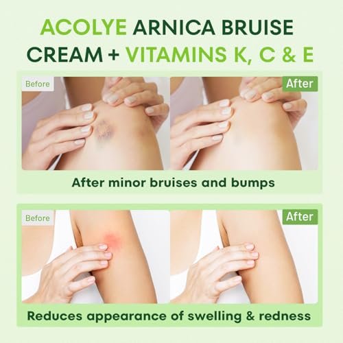 Acolye Arnica Cream for Bruising and Swelling – Extra Strength with Vitamins K, C, E for Seniors 55+ (3.5 oz) Avelisse