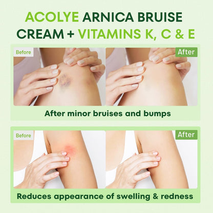 Acolye Arnica Cream for Bruising and Swelling – Extra Strength with Vitamins K, C, E for Seniors 55+ (3.5 oz) Avelisse