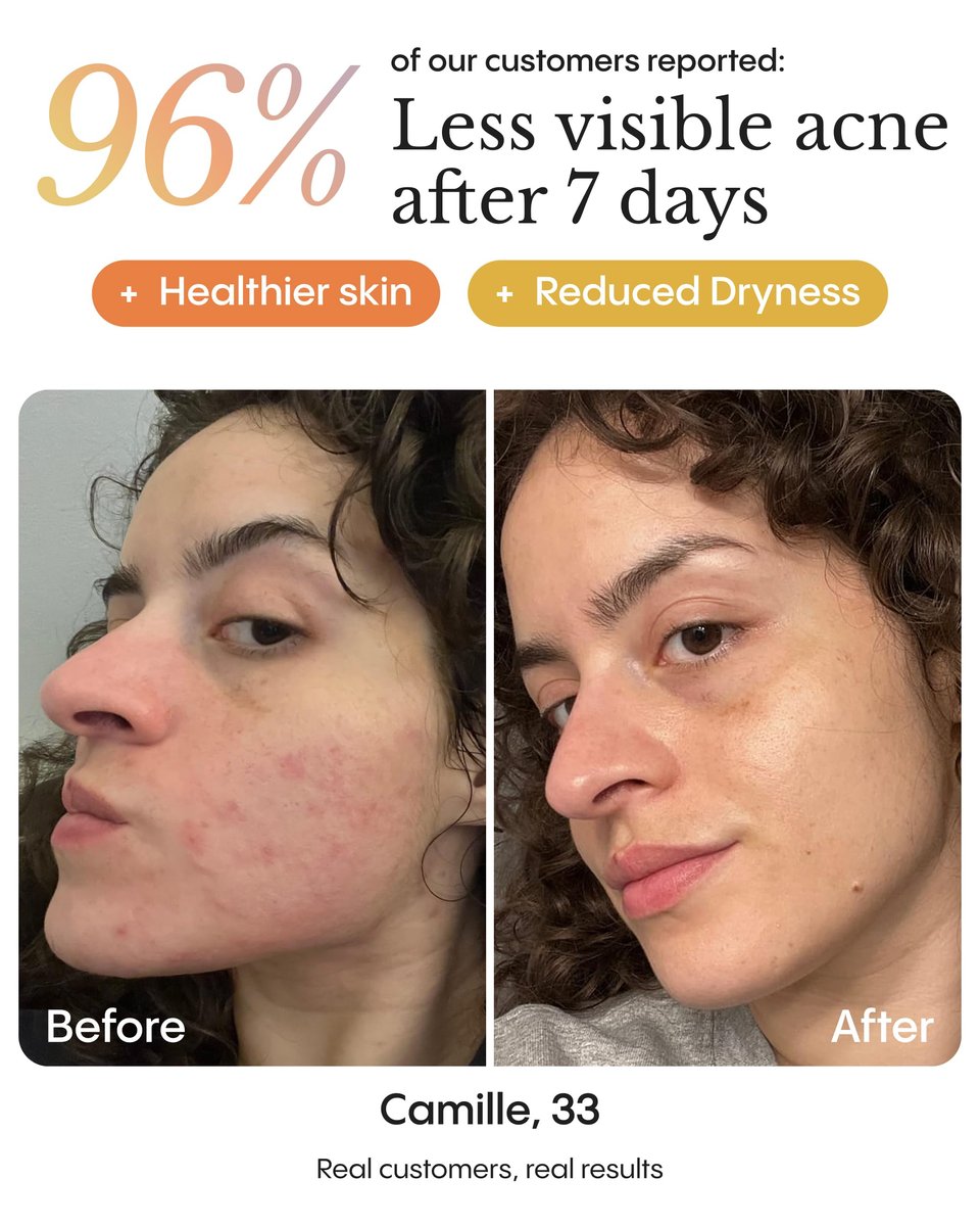 Frøya Organics The Complete Blemish System for Women – 60-Day Supply with Magic Revive & Glow Day Balm, Ultra Cleanse & Revive Face Scrub, Instant Rosacea, Acne & Redness Stopper Avelisse