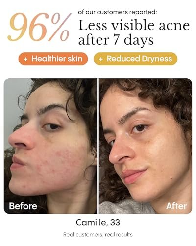 Frøya Organics The Complete Blemish System for Women – 60-Day Supply with Magic Revive & Glow Day Balm, Ultra Cleanse & Revive Face Scrub, Instant Rosacea, Acne & Redness Stopper Avelisse