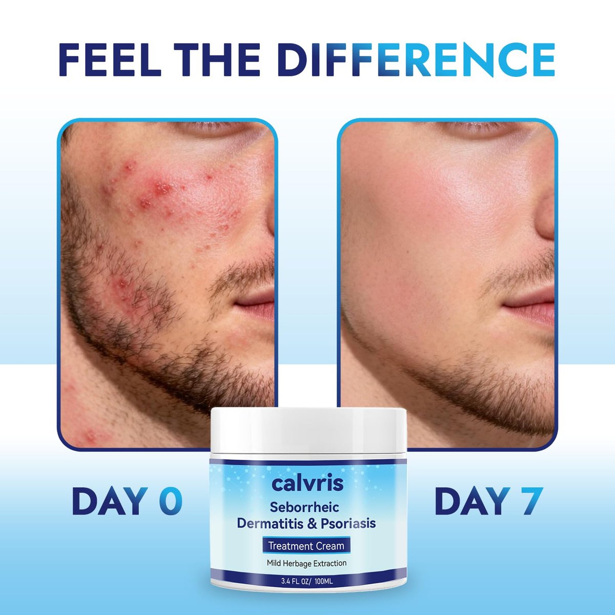 Calvris Scalp Comfort Balm - Steroid-Free Botanical Formula for Dry, Itchy Scalp & Skin, 3.4 Fl Oz | Natural Soothing Relief with Cooling Sensation Avelisse