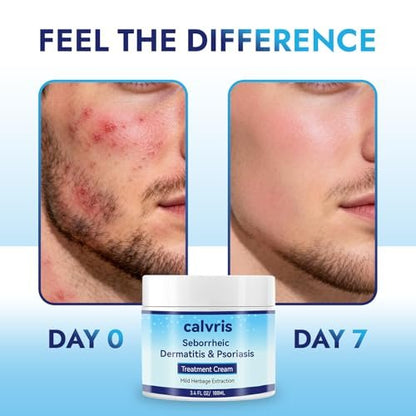 Calvris Scalp Comfort Balm - Steroid-Free Botanical Formula for Dry, Itchy Scalp & Skin, 3.4 Fl Oz | Natural Soothing Relief with Cooling Sensation Avelisse