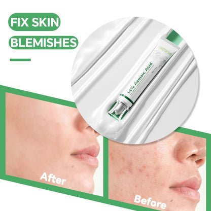 14% Azelaic Acid Serum for Face – Gentle Acne & Redness Treatment, Calms Sensitive Skin, Improves Blemishes & Uneven Tone, Lightweight Formula 1oz