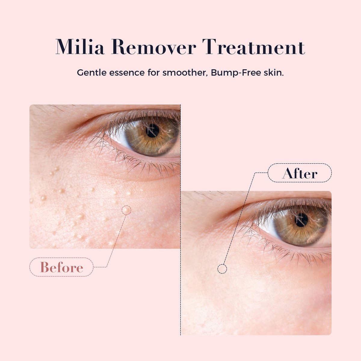 Kisinly Milia Remover for Eye & Face - Milia Spot Treatment Serum with Salicylic Acid, Milia Acne Cream (0.5 Fl Oz) Avelisse