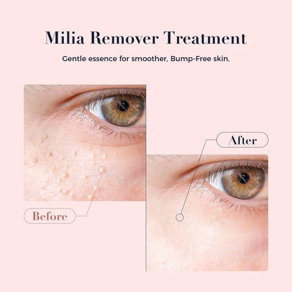 Kisinly Milia Remover for Eye & Face - Milia Spot Treatment Serum with Salicylic Acid, Milia Acne Cream (0.5 Fl Oz) Avelisse