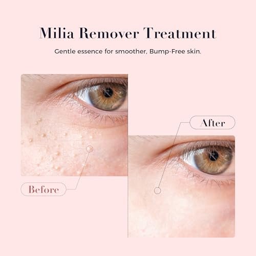 Kisinly Milia Remover for Eye & Face - Milia Spot Treatment Serum with Salicylic Acid, Milia Acne Cream (0.5 Fl Oz) Avelisse