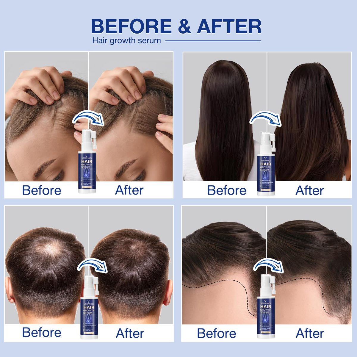 VENANOCI Hair Growth Oil Spray - Natural Hair Regrowth Serum with Rosemary & Biotin for Thicker, Fuller Hair | Anti-Hair Loss Treatment for Women and Men Avelisse