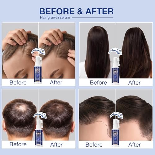 VENANOCI Hair Growth Oil Spray - Natural Hair Regrowth Serum with Rosemary & Biotin for Thicker, Fuller Hair | Anti-Hair Loss Treatment for Women and Men Avelisse