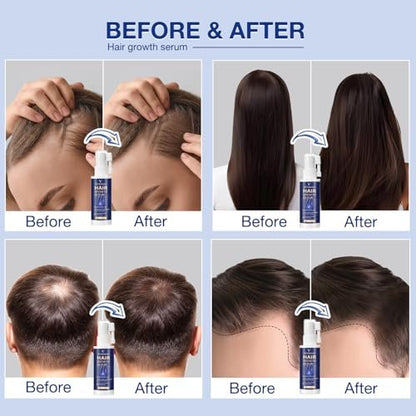 VENANOCI Hair Growth Oil Spray - Natural Hair Regrowth Serum with Rosemary & Biotin for Thicker, Fuller Hair | Anti-Hair Loss Treatment for Women and Men Avelisse