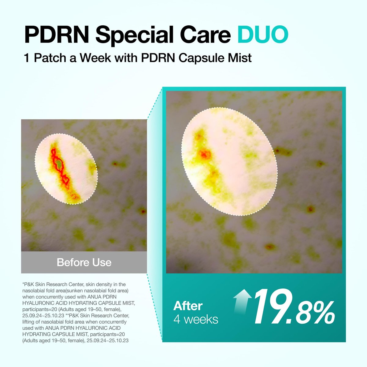 Anua Salmon DNA PDRN Collagen Melting Patch for Glass Skin - Smile Line & Wrinkle Patches, Firming Fine Lines, Hydrating, Korean Skincare, 2 Pairs x 4EA Avelisse