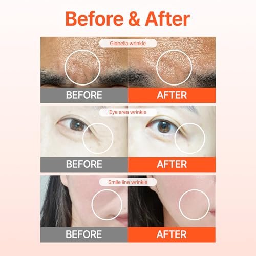 ACROPASS RETI-RN Microcone Wrinkle Patches – Deep Wrinkle Treatment with PDRN 10,000 ppm, Retinol, Hyaluronic Acid – Anti-Aging Slim Type, 6 Count Avelisse