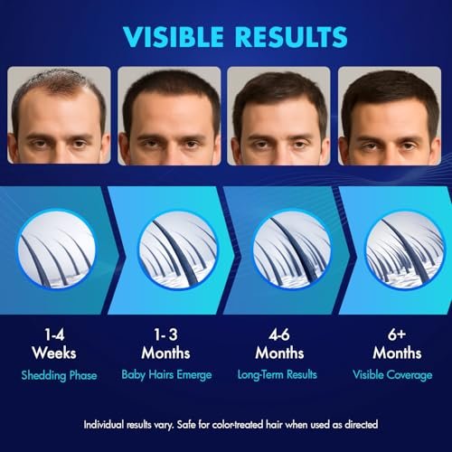 Extra Strength 5% Minoxidil Hair Growth Treatment for Men and Women – Topical Solution with Biotin for Receding Hairlines & Vertex Thinning (2-Pack, 1 Fl Oz Each) Avelisse