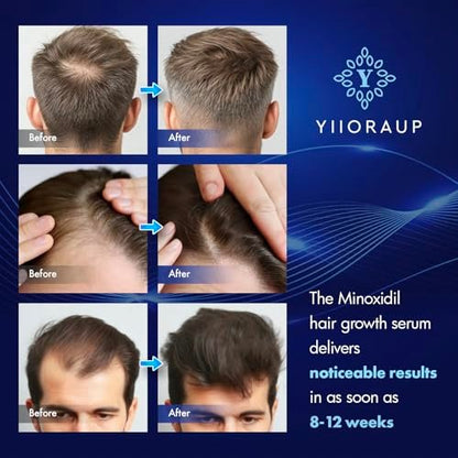 Extra Strength 5% Minoxidil Hair Growth Treatment for Men and Women – Topical Solution with Biotin for Receding Hairlines & Vertex Thinning (2-Pack, 1 Fl Oz Each) Avelisse