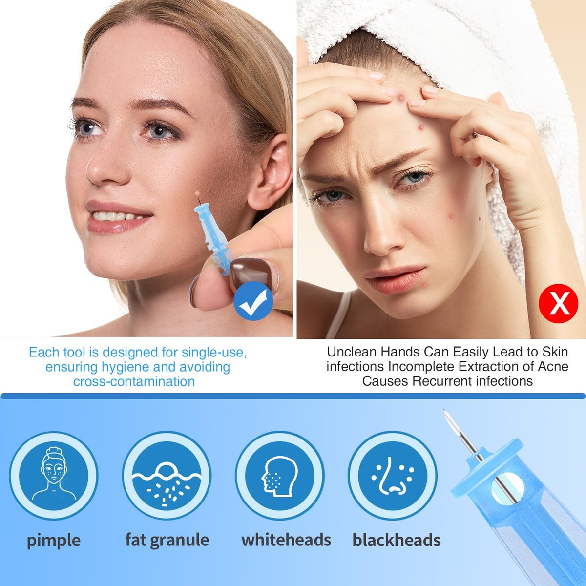 MixS Live Sterile Pimple Needle Kit - 80 Ultra-Fine Acne Needles + 108 Acne Pimple Stickers for Blackhead and Blemish Removal - Clear Skin Solution - görsel 5