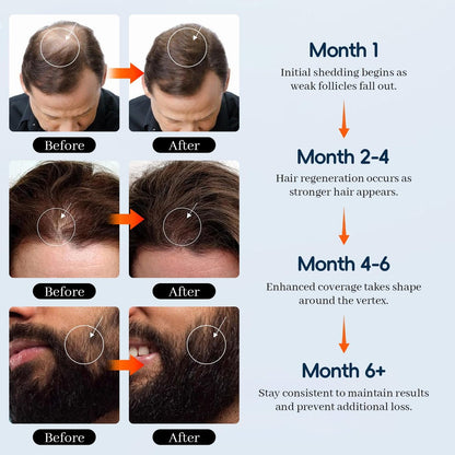 5% Minoxidil for Men and Women - Hair & Beard Growth Treatment with Biotin & Rosemary - Extra Strength Hair Loss Serum, 4 oz