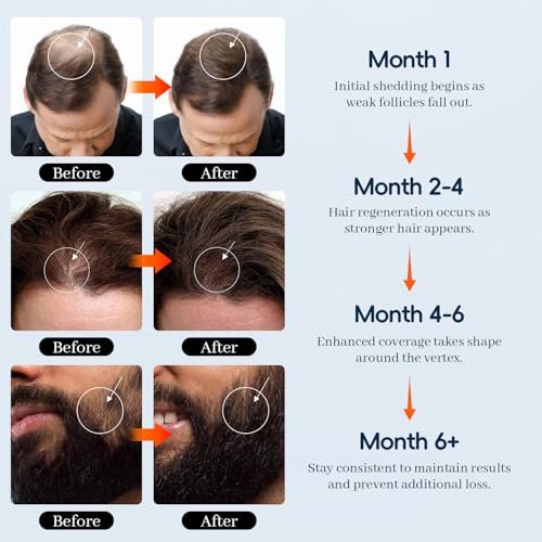5% Minoxidil for Men and Women - Hair & Beard Growth Treatment with Biotin & Rosemary - Extra Strength Hair Loss Serum, 4 oz - görsel 12