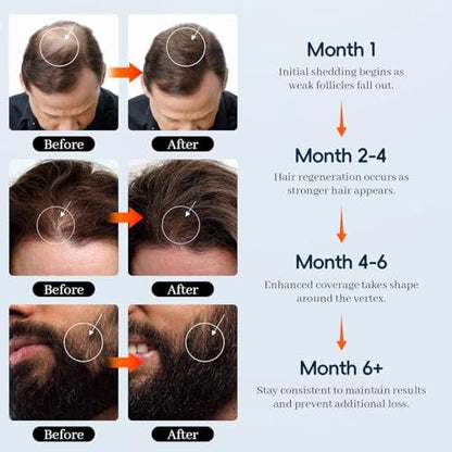 5% Minoxidil for Men and Women - Hair & Beard Growth Treatment with Biotin & Rosemary - Extra Strength Hair Loss Serum, 4 oz