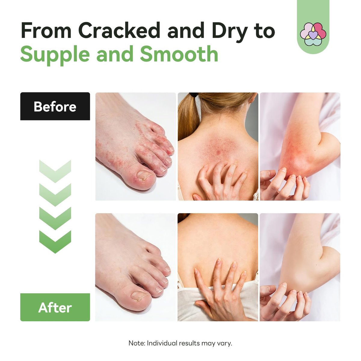 SAVILAND Antifungal Cream - Max Strength 25% Undecylenic Acid, FSA/HSA Eligible, 4.23 oz - Treats Athlete's Foot, Jock Itch, Ringworm with Tea Tree & Oregano Oil Avelisse
