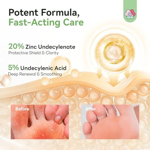 SAVILAND Antifungal Cream - Max Strength 25% Undecylenic Acid, FSA/HSA Eligible, 4.23 oz - Treats Athlete's Foot, Jock Itch, Ringworm with Tea Tree & Oregano Oil Avelisse