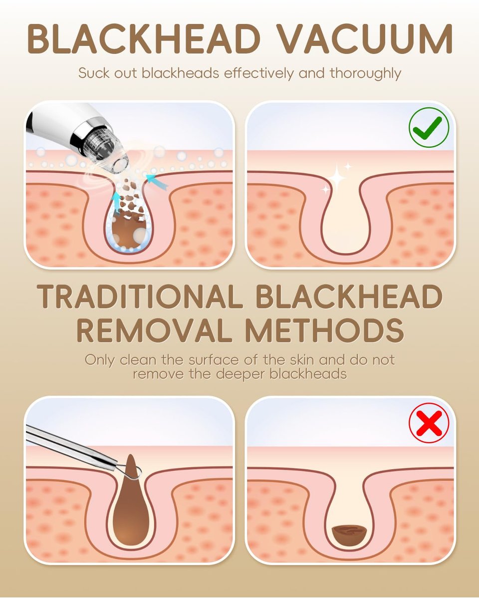 Rechargeable Blackhead Vacuum Pore Cleaner - 5 Attachments & 3 Suction Levels for Deep Facial Cleansing, USB-Powered Blackhead Remover for Women and Men (White) Avelisse